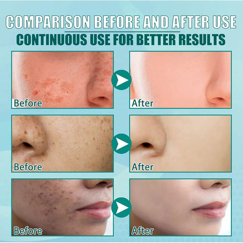 

See the difference with consistent use. From dark spots and acne scars to smooth, clear, glowing skin — our product is designed to transform your complexion safely and effectively.

Try it now and feel the change.