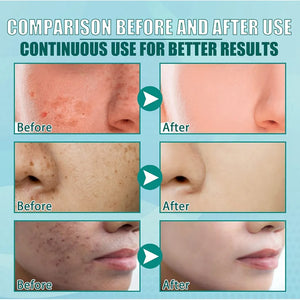 

See the difference with consistent use. From dark spots and acne scars to smooth, clear, glowing skin — our product is designed to transform your complexion safely and effectively.

Try it now and feel the change.